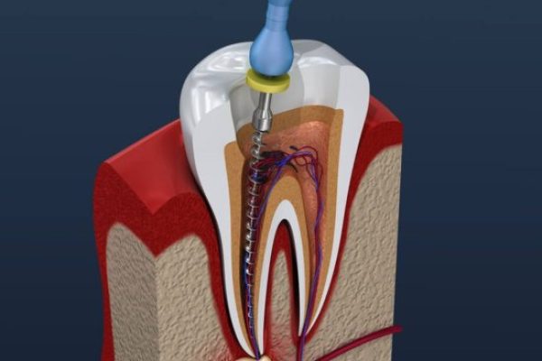 Endodontics-Root-Canal-Treatment-qnpyf66gjn49i8zop53l844c8w0lxzm7vw34jcxa14